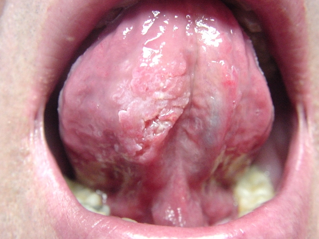 cancer of tongue